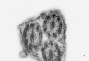 M,8y. | immotile cilia syndrome - bronchus M,8y. | immotile cilia syndrome - bronchus